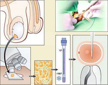 经皮附睾精子抽吸术/睾丸穿刺取精